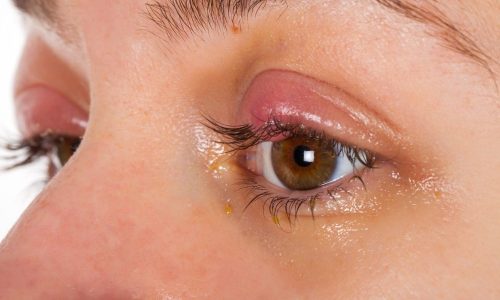 Chalazion Surgery