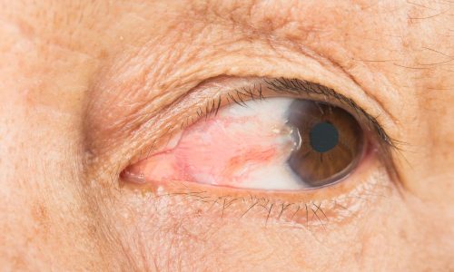 Pterygium Surgery