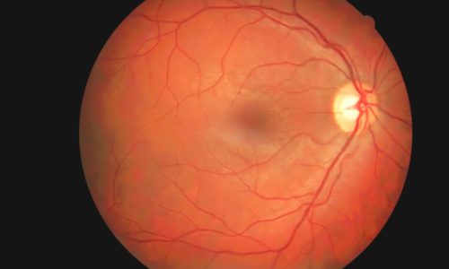 Retina Evaluation